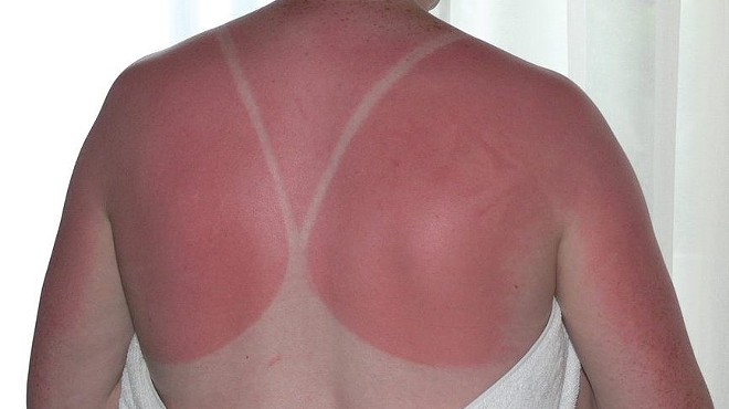 A woman's back with a sunburn