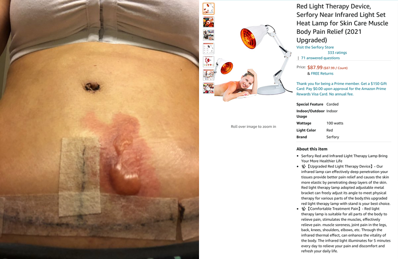 A third-degree burn on Amanda Jeffries' stomach alongside the Amazon listing for the light therapy lamp that allegedly caused the injury. The U.S. Consumer Product Safety Commission found over 400,000 hazardous products sold on Amazon.