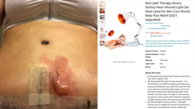 A third-degree burn alongside a Amazon listing for the light therapy lamp