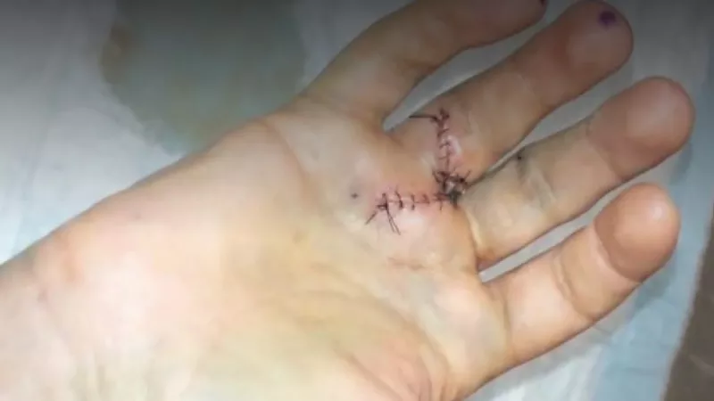 Image: A photo of Trevor Hughes hand after surgery.