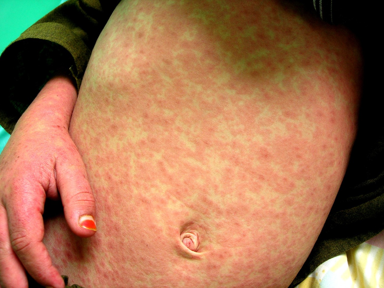 Three unvaccinated children tested positive for measles last week.