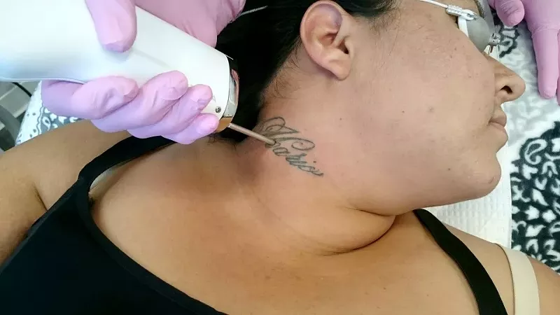 Image: A woman begins the process of having a tattoo removed at youbaby Skin Spa.