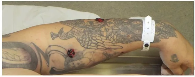 Denver DA Mitch Morrissey used the bullet holes in Dion Damon's arm, as seen in this post-mortem photo, in his decision letter that found Officer Jeffrey Motz's actions justified. - DENVER DISTRICT ATTORNEY'S OFFICE