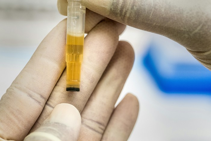 Urine sample held by lab gloves