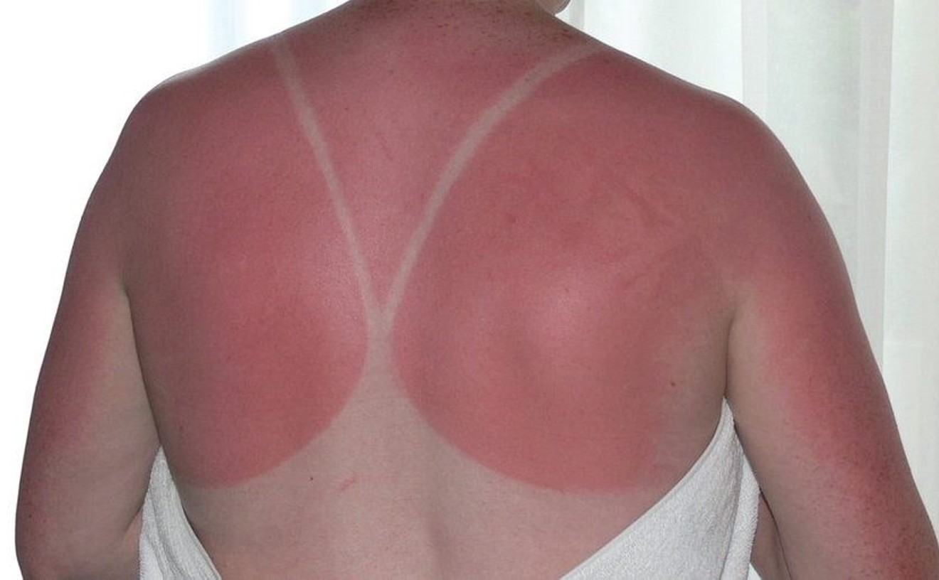 Can CBD Improve Sunscreen or Burn Cream?