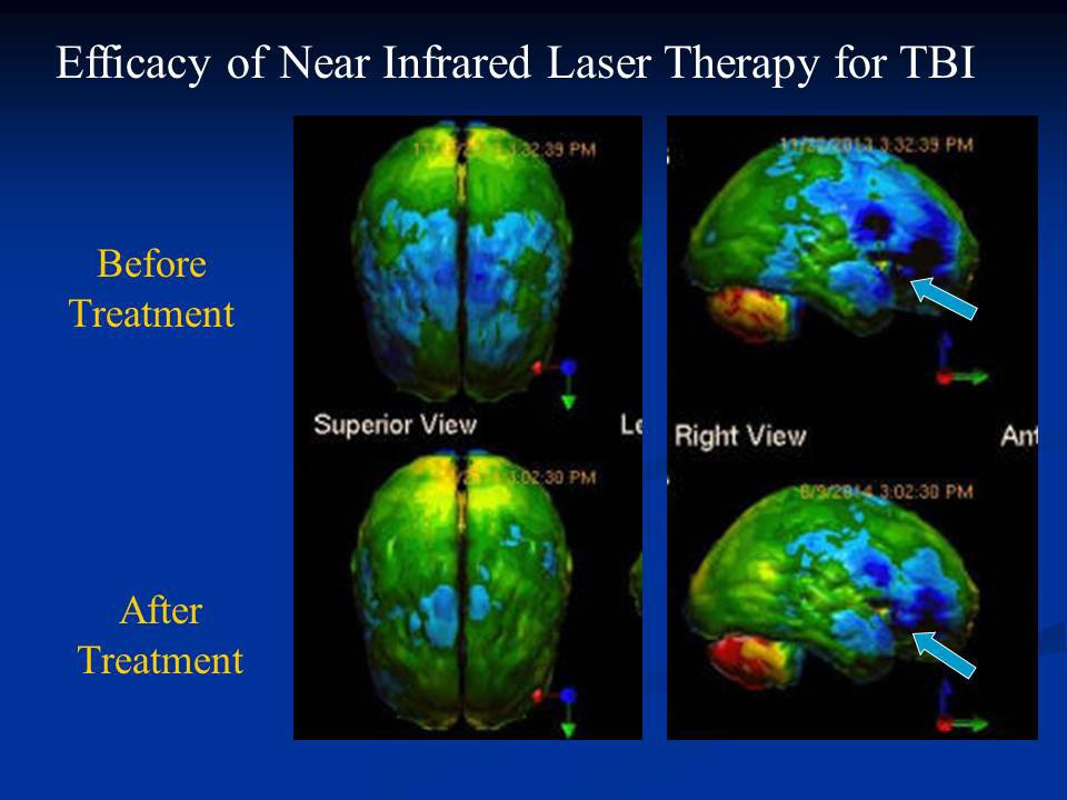 laser one touch va neurology