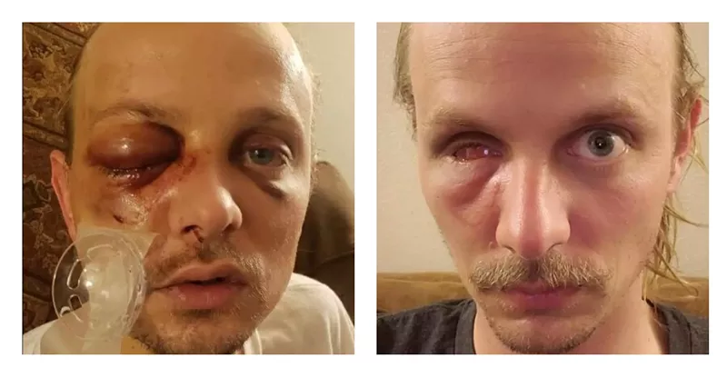 Image: Photos of Russell Strong before and after surgery that resulted in the removal of his eye.