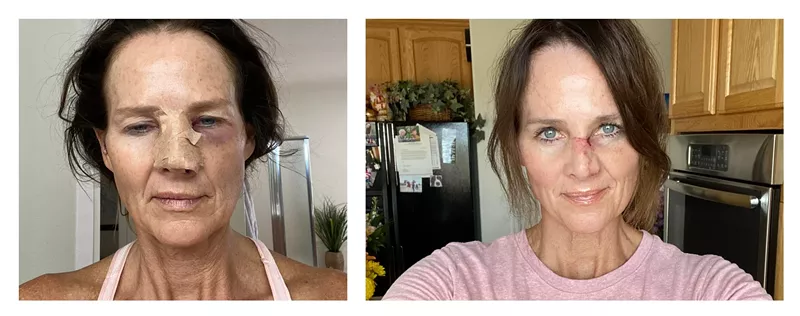 Image: Kathy Sabine following surgery and in a selfie taken yesterday, July 18.